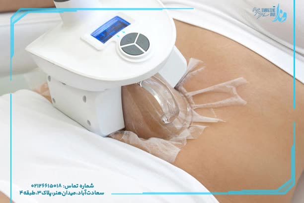کرایولیپولیز شکم