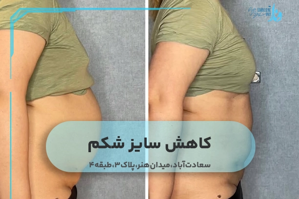 کاهش سایز شکم