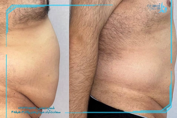 بهترین دستگاه برای کاهش سایز شکم