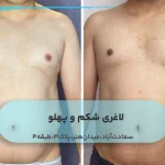 لاغری شکم و پهلو