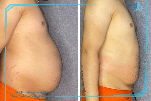 کاهش چربی شکم و پهلو بدون رژیم سخت کاهش چربی شکم و پهلو بدون رژیم سخت